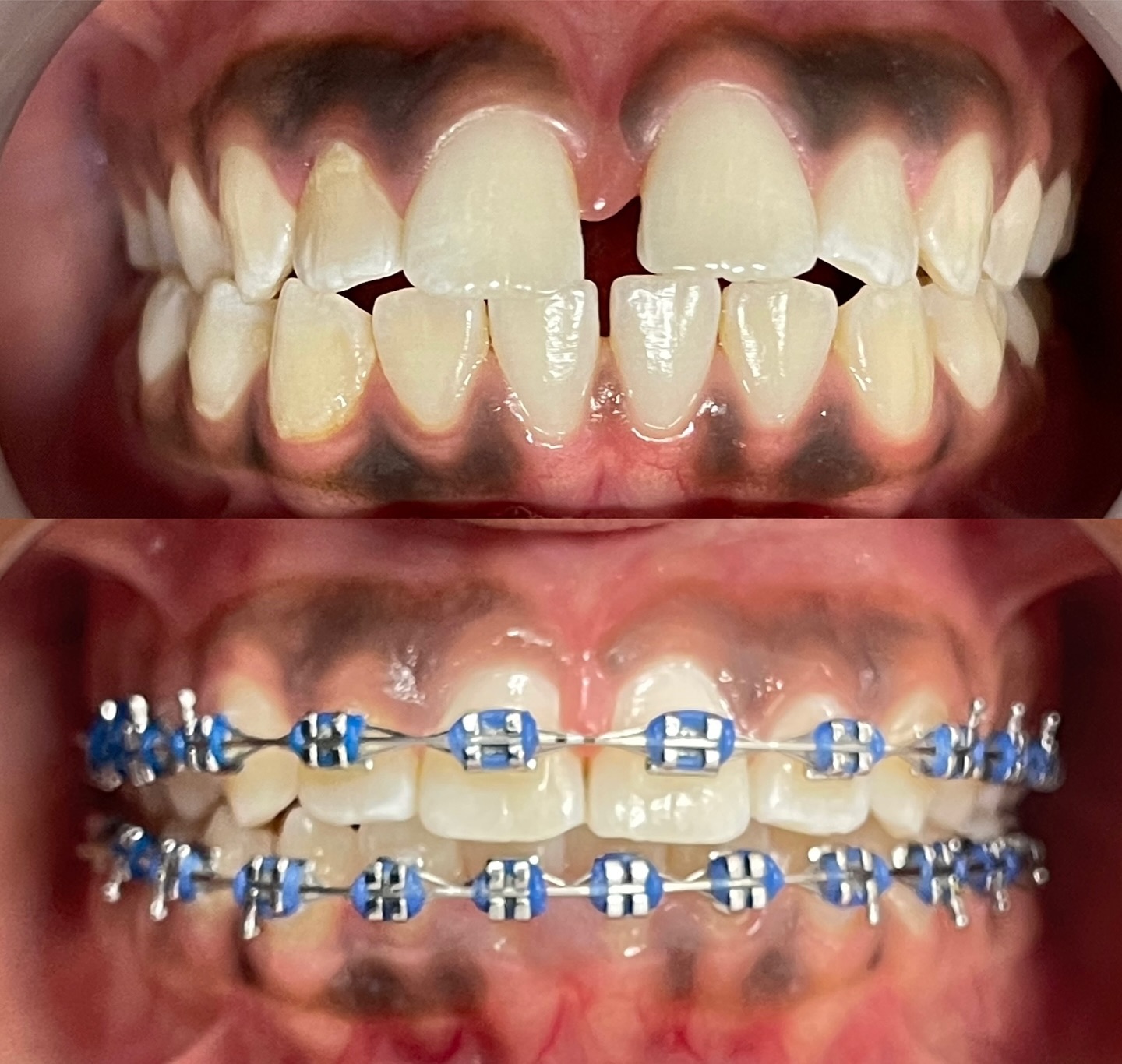 Braces transformation 11